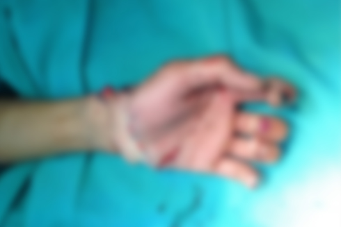 Bàn tay của bệnh nhân D. sau khi được nối