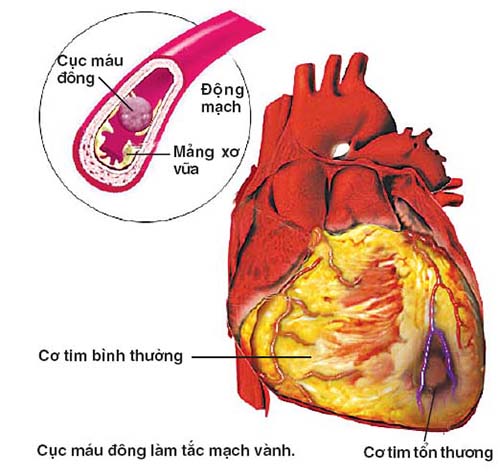Cục máu đông đã được hình thành trong buồng tim, nguy cơ nó có thể bong ra, xuống tâm thất trái, vào vòng đại tuần hoàn gây tắc mạch là rất lớn.