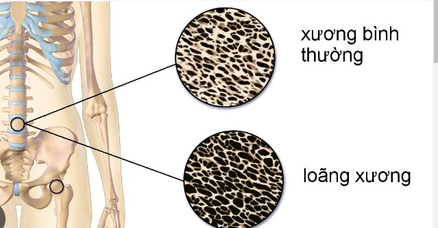 6 loại thực phẩm hàng đầu ngăn ngừa loãng xương