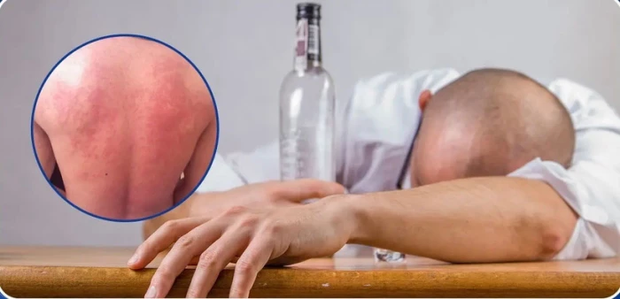 “Mẩn ngứa, nóng bừng” do rượu, bia không đơn thuần là say rượu