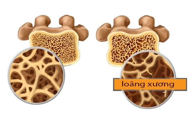 Hạt dưa giúp giảm tình trạng loãng xương.