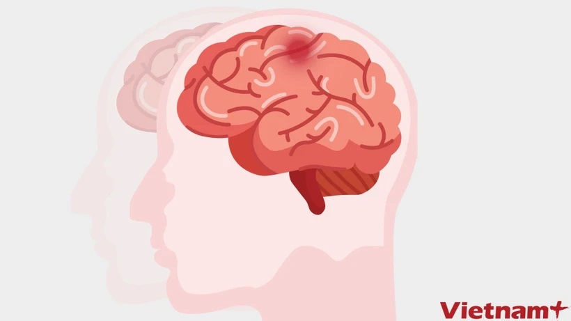 Phát hiện mới về hoạt động của não liên quan đến chứng tự kỷ