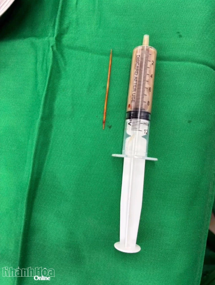 Phẫu thuật cứu bệnh nhân nuốt tăm tre xuyên tá tràng, đâm thủng thận