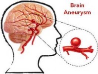 Phát hiện sớm phình động mạch não