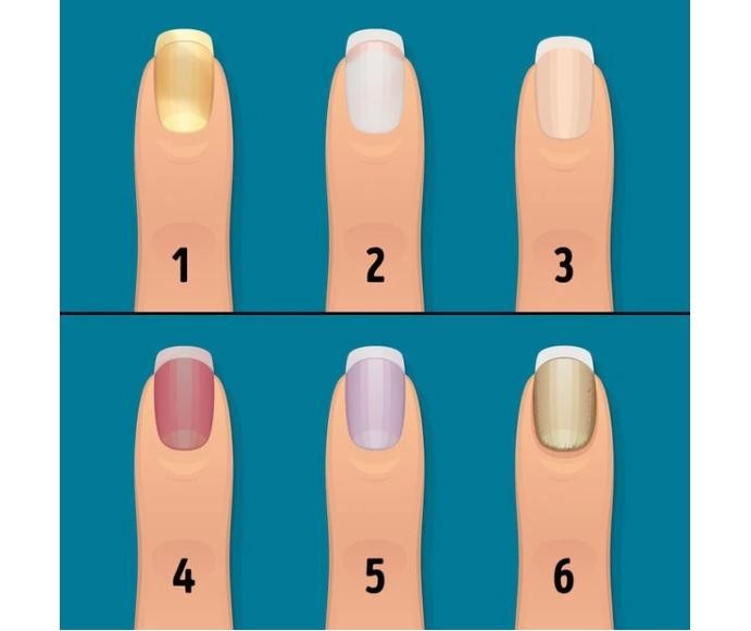 6 thay đổi ở móng tay biểu hiện cơ thể đang thiếu vitamin quan trọng