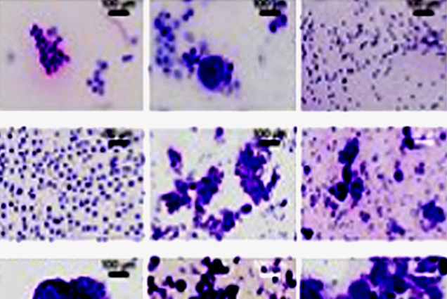Ứng dụng AI để dự đoán chính xác hơn nguồn gốc các khối u 