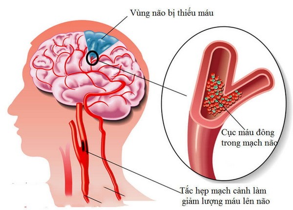 Dấu hiệu của thiếu máu não đừng chủ quan đột quỵ như chơi