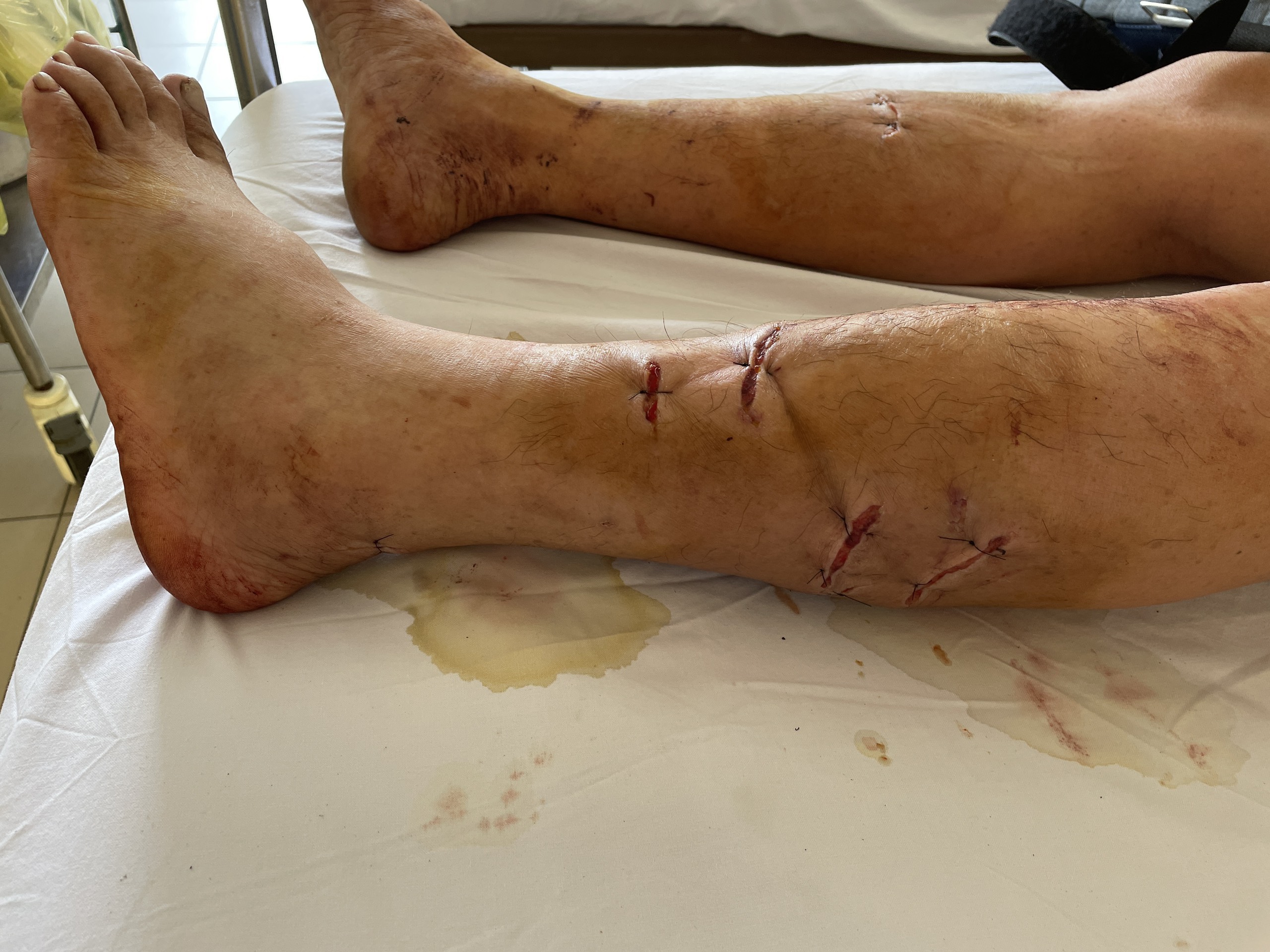 Bị khỉ cắn, hai vợ chồng nhập viện