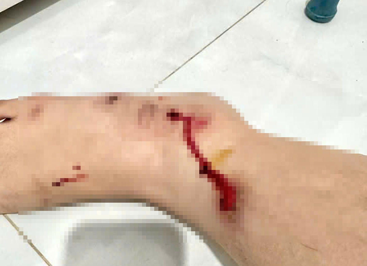 Cướp giật điện thoại, kéo lê nạn nhân trên đường một đoạn dài