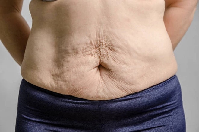 Da chảy xệ do giảm cân quá nhanh. (Ảnh: iStock)
