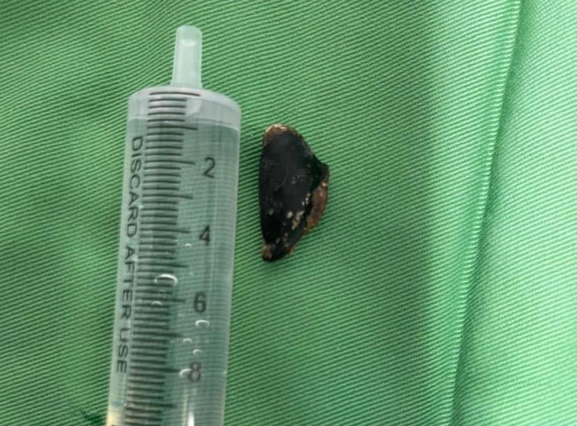 Bệnh viện Đa khoa tỉnh Khánh Hòa gắp thành công dị vật nằm trong cơ thể người bệnh 20 năm