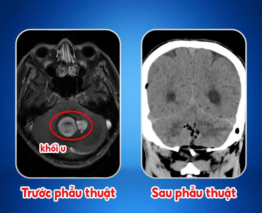 Hình  ảnh  CT Scanner trước  và  sau  phẫu  thuật  của  bệnh  nhân