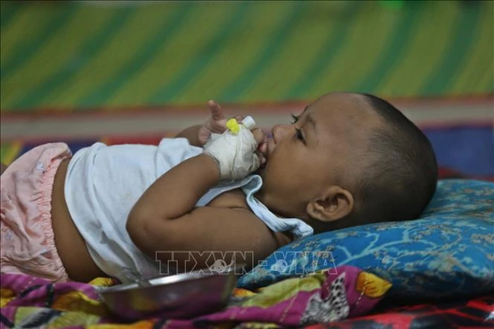 Hàng trăm trẻ em thiệt mạng do bùng phát dịch sởi tại Bangladesh