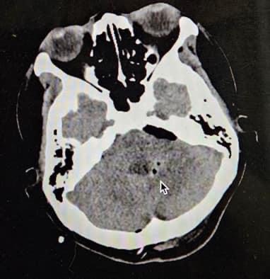 Bệnh viện Đa khoa tỉnh Khánh Hòa:: Điều trị thành công trường hợp u não màng nội tủy