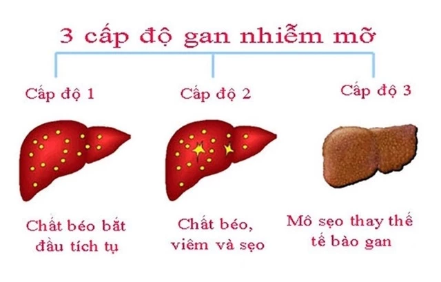 6 cách ngăn ngừa và kiểm soát bệnh gan nhiễm mỡ an toàn và hiệu quả