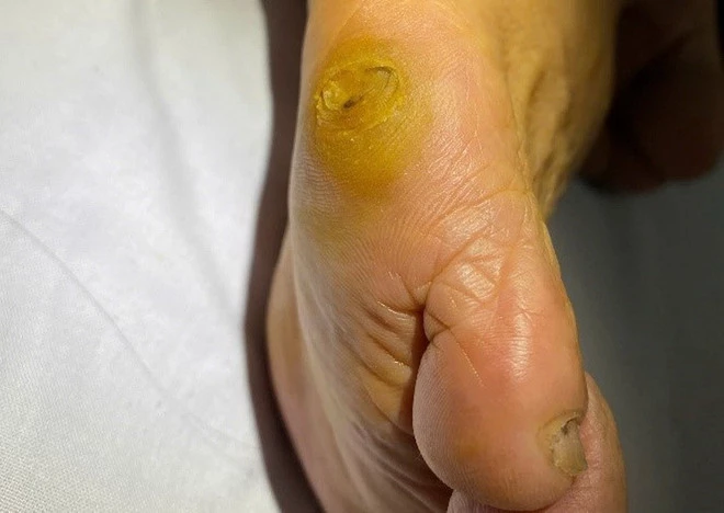 Vết chai chân. (Nguồn: Bệnh viện Trung ương Quân đội 108)