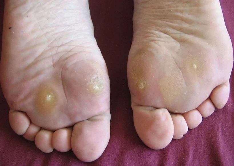 Vì sao chai chân lại gây đau nhức và cách xử lý, phòng ngừa hiệu quả