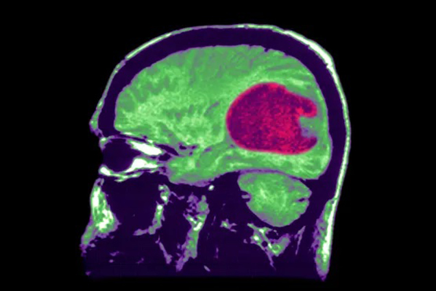 Trí tuệ nhân tạo có thể điều trị u não nhanh và chính xác hơn