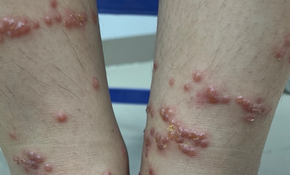 Lưu ý khi đụng phải sứa biển