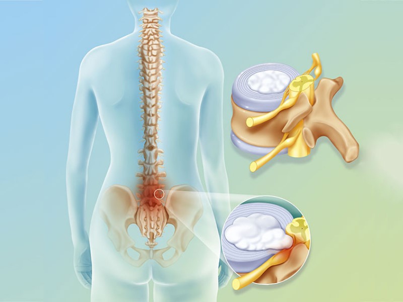 Bệnh thoát vị đĩa đệm có xu hướng “trẻ hóa”