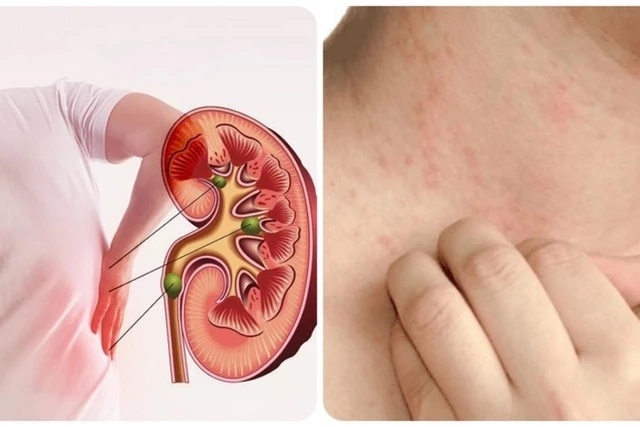 7 việc nên làm để phòng nguy cơ suy thận