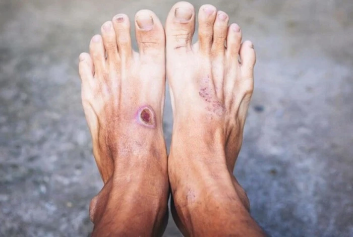 Vì sao vết loét trên da của người tiểu đường thường khó lành?