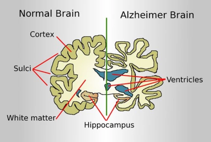 Phát hiện cơ chế giúp não tự làm sạch, mở ra hy vọng chữa Alzheimer