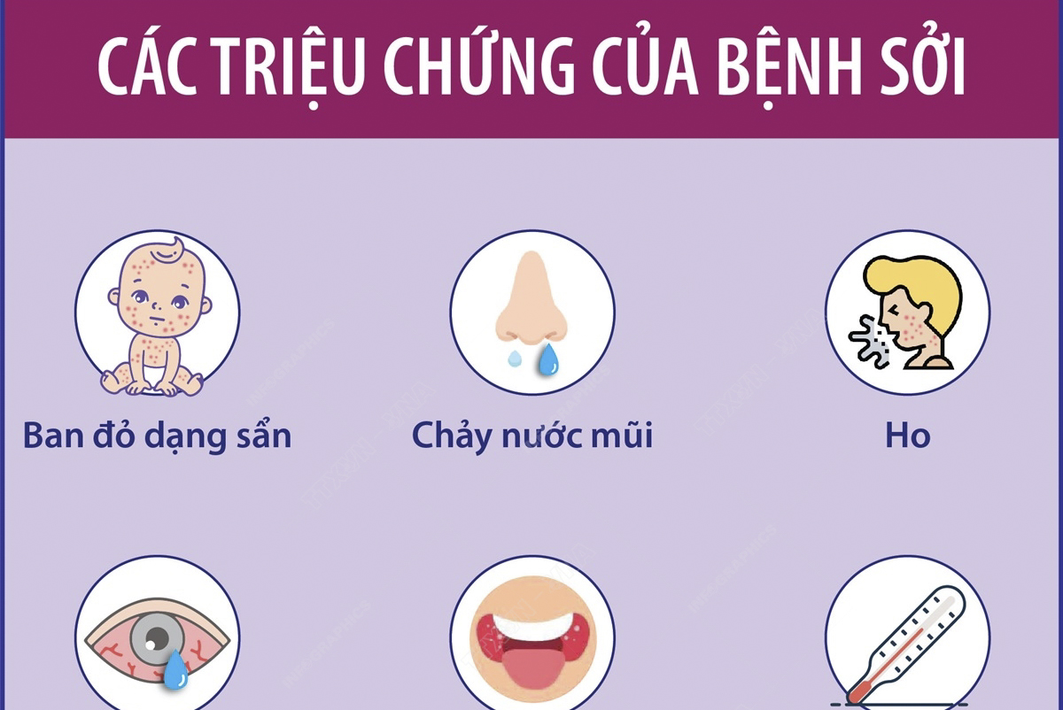 Các triệu chứng của bệnh sởi