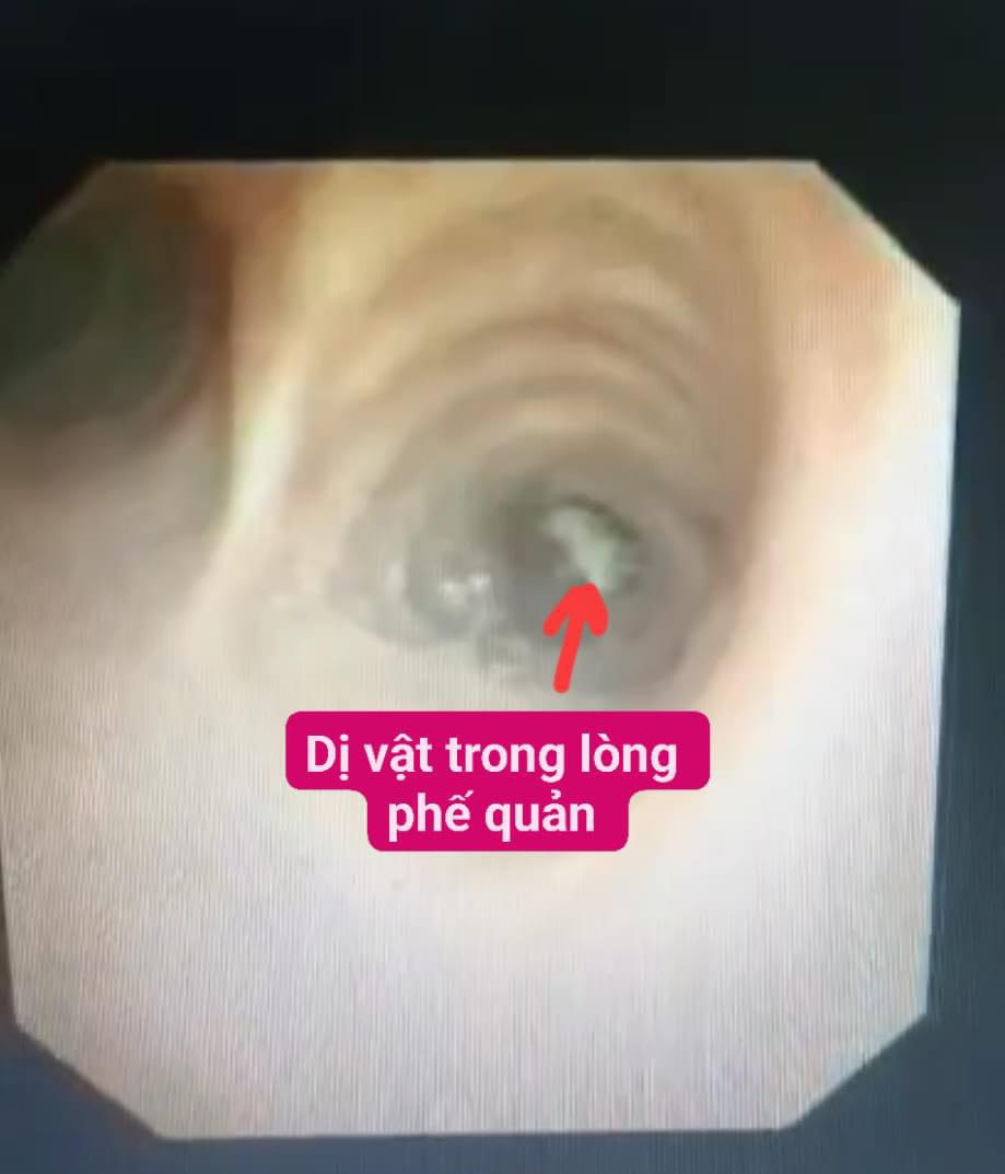 Dị vật trong lòng phế quản