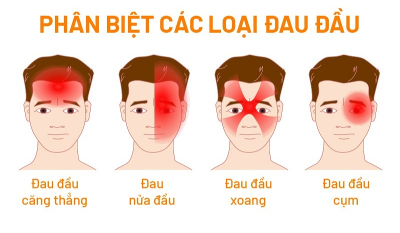 Các loại đau đầu và vị trí thường gặp.