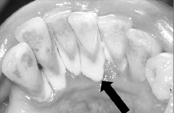 Mảng bám không được loại bỏ dẫn đến các bệnh răng miệng.