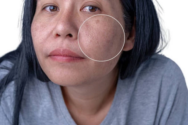 Hình ảnh làn da xỉn màu và thô ráp. (Ảnh: iStock)