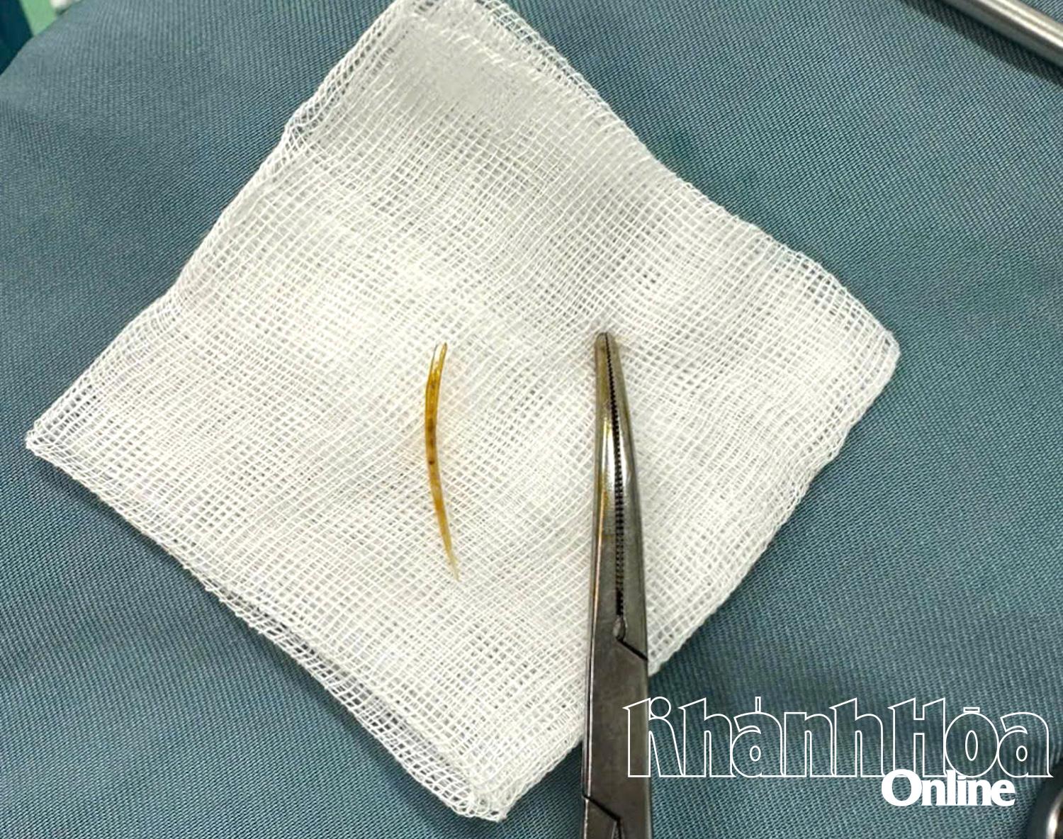 Dị vật đâm thủng ruột bệnh nhân.