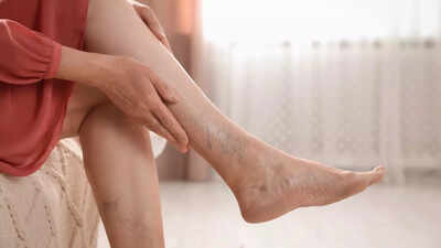 Giãn tĩnh mạch là lời cảnh báo hệ tuần hoàn đang gặp trục trặc.