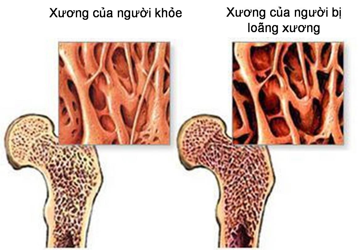 Xương là mô sống liên tục được đổi mới trong suốt cuộc đời, với các tế bào cũ được thay thế bằng các tế bào mới. Nếu tốc độ tiêu hủy vượt quá tốc độ hình thành, xương sẽ yếu đi theo thời gian, dẫn đến loãng xương.