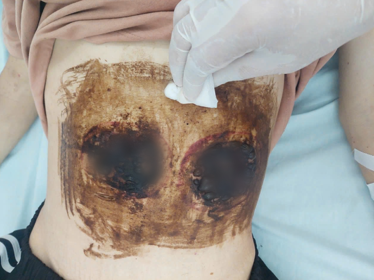 Những ai không nên giác hơi?