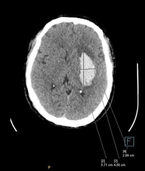 Ổ tổn thương não do đột quỵ.