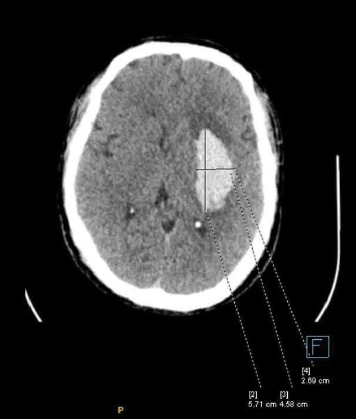 Nguy cơ đột quỵ khi bạn tự ý ngưng thuốc huyết áp