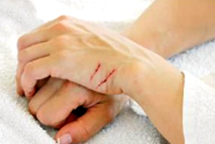 Israel phát triển keo dán vết thương trong 5 giây