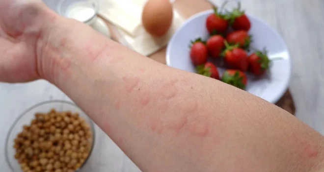 Ảnh minh họa. (Nguồn: Food Allergies Atlanta)