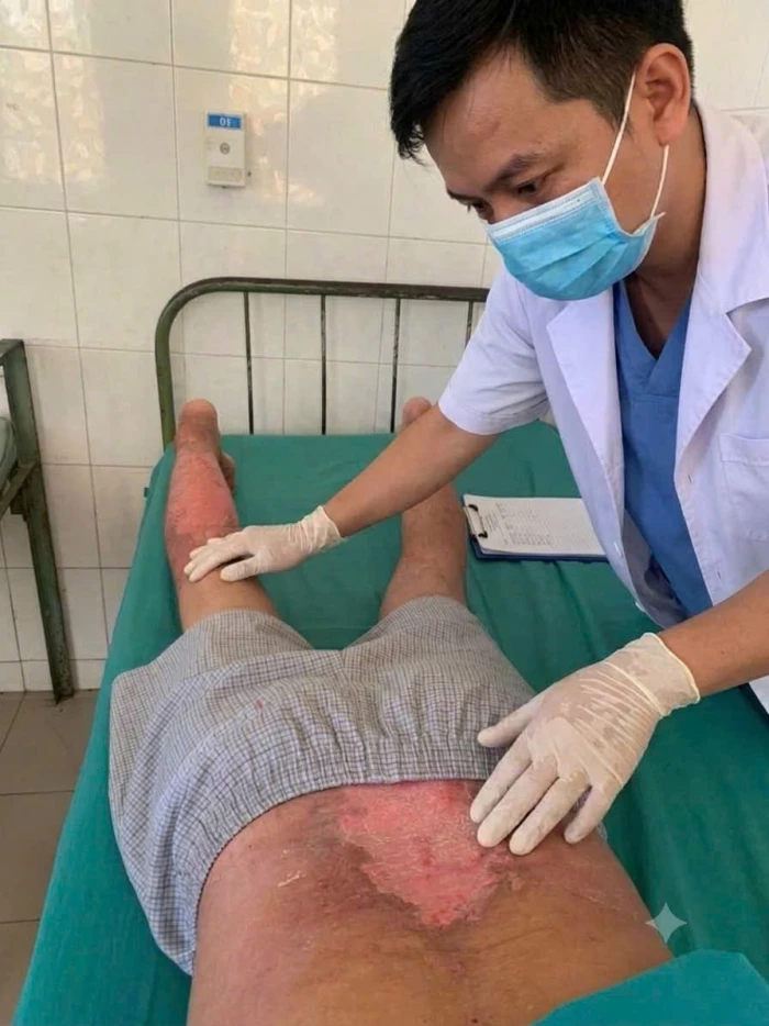 Bị bỏng da vì đắp tỏi, rượu để chữa đau