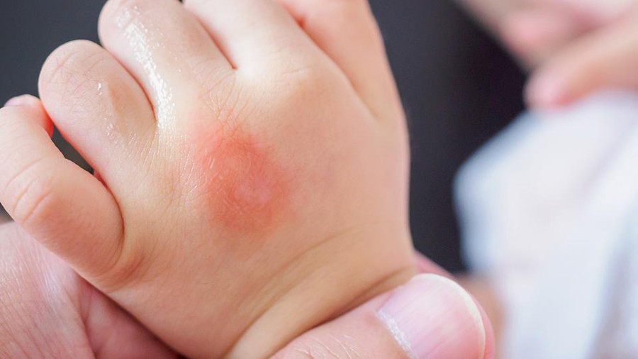 12 nhóm người được muỗi yêu thích nhất