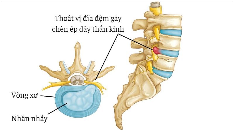 Thoát vị đĩa đệm có thể gây đau lưng dưới...