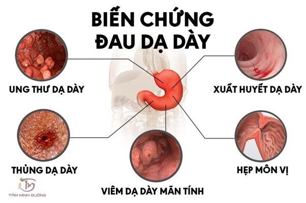 Các bệnh thường gặp về dạ dày ai cũng nên biết