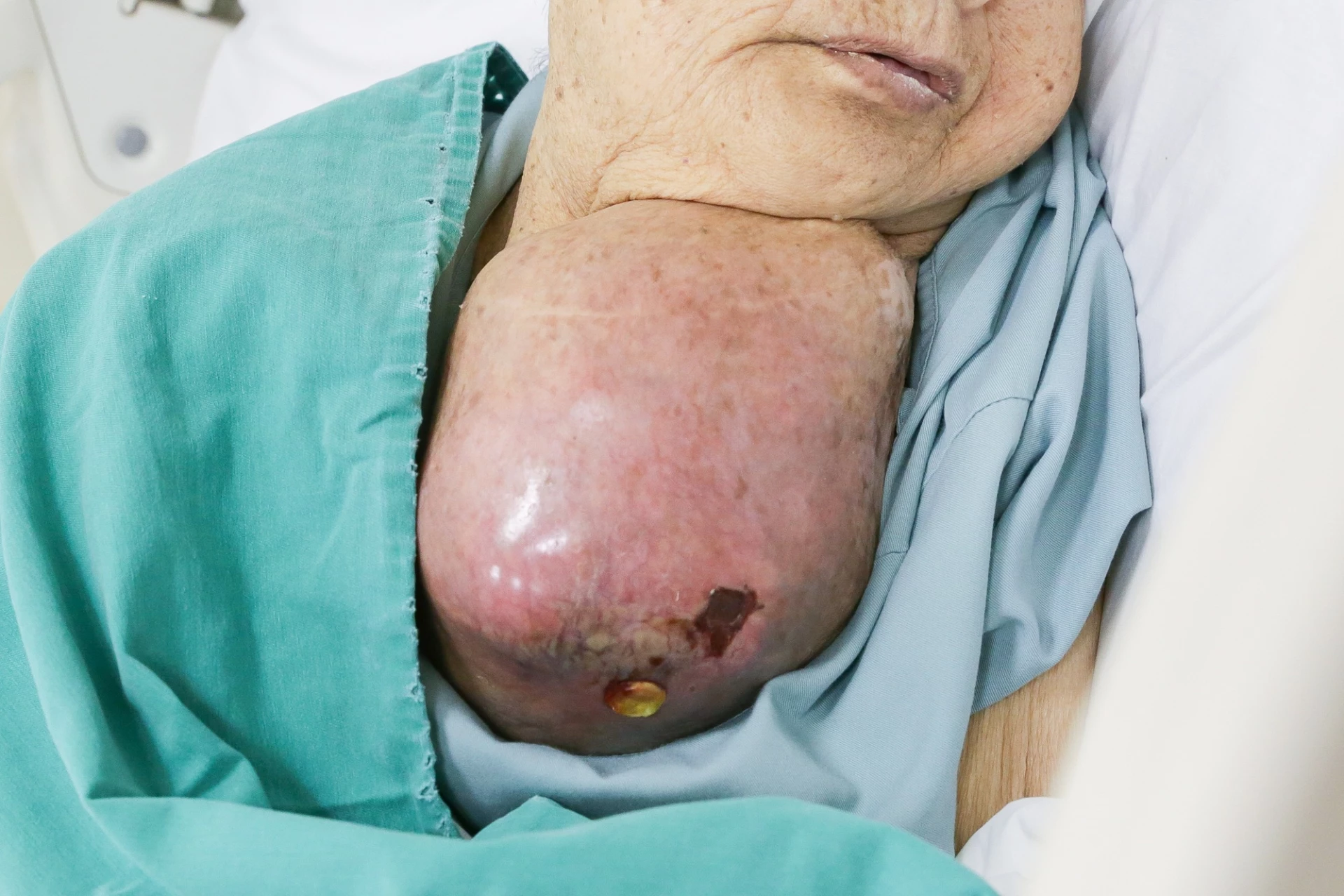 Khối u khổng lồ chèn ép vùng cổ bệnh nhân.