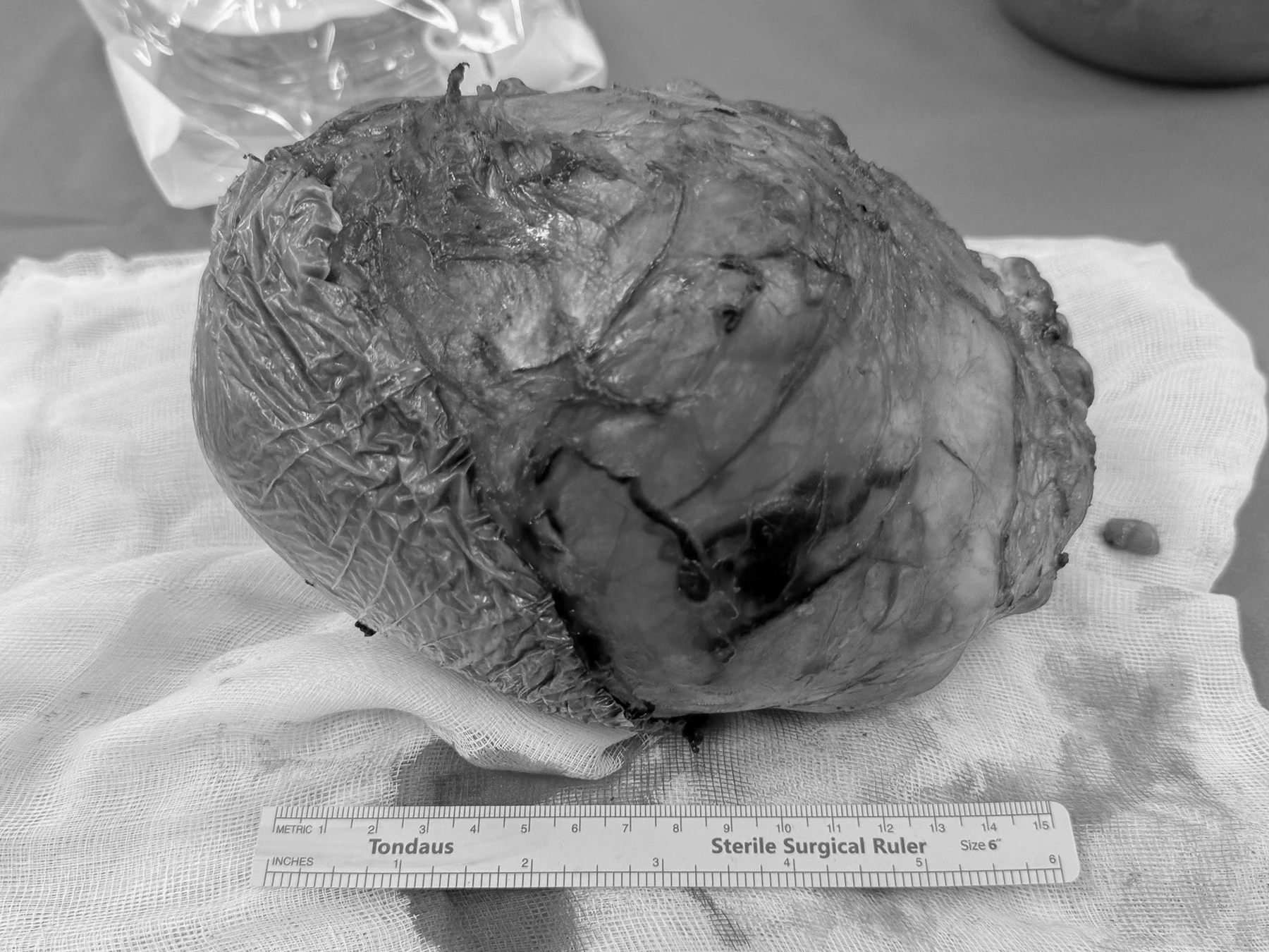 Khối u nặng khoảng 1,7kg,