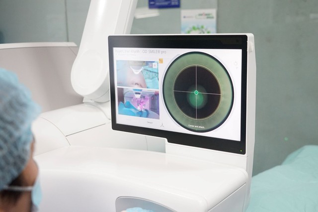 Một lần laser của SMILE pro có thể điều trị đến 10 độ cận, 5 độ loạn chỉ trong 8 giây 
