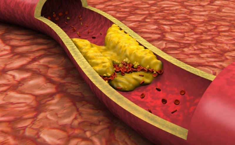 Tăng mỡ máu có thể gây ra những biến chứng nguy hiểm đối với sức khỏe người cao tuổi.