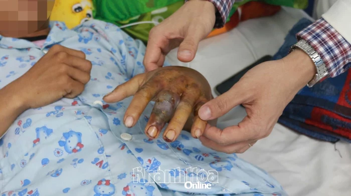 Bệnh viện Đa khoa Ninh Thuận cứu sống bệnh nhân bị rắn cắn