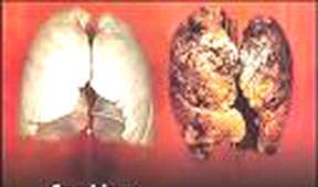 Phát hiện mới về tác hại do hút thuốc lá